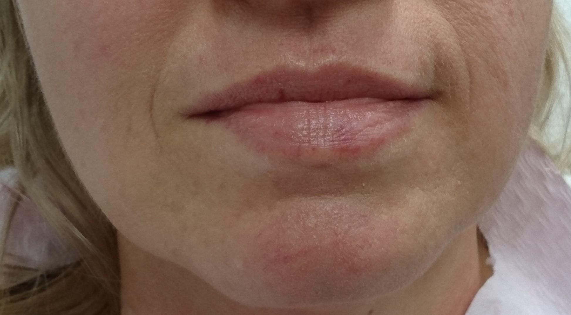 Powiększanie i nawilżanie ust | Dermatolog - Wrocław 1